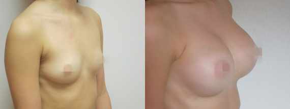 Foto před a po zvětšení prsou
