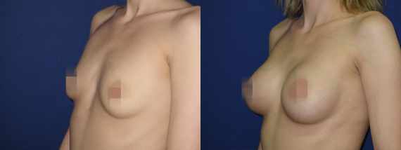 Foto před a po zvětšení prsou