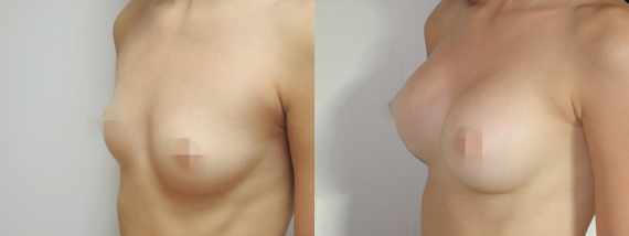 Foto před a po zvětšení prsou