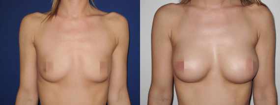 Foto před a po zvětšení prsou