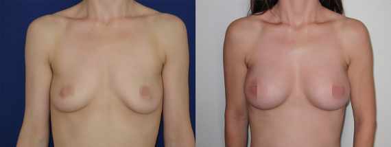 Foto před a po zvětšení prsou