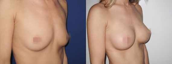 Foto před a po zvětšení prsou