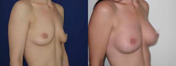 Foto před a po zvětšení prsou