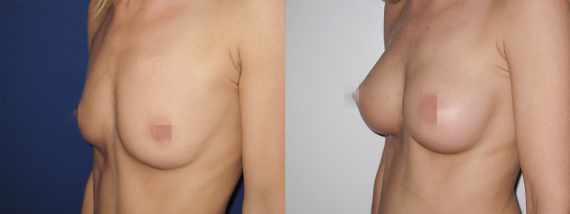 Foto před a po zvětšení prsou