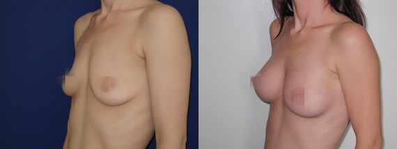 Foto před a po zvětšení prsou