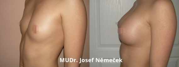 Foto před a po zvětšení prsou