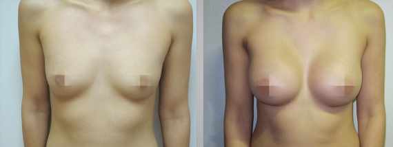 Foto před a po zvětšení prsou