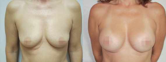 Foto před a po zvětšení prsou