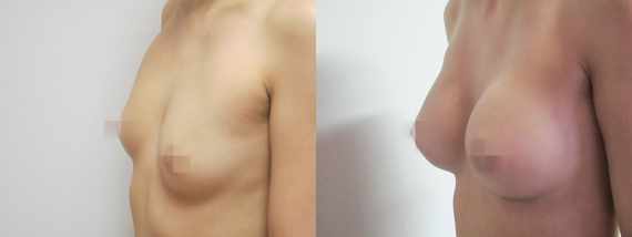 Foto před a po zvětšení prsou
