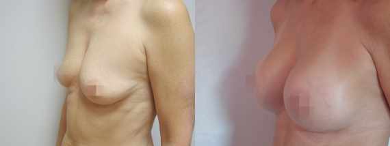 Foto před a po zvětšení prsou