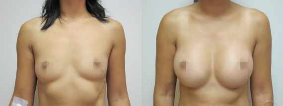 Foto před a po zvětšení prsou