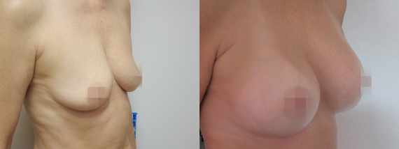 Foto před a po zvětšení prsou