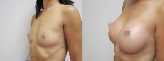Foto před a po zvětšení prsou