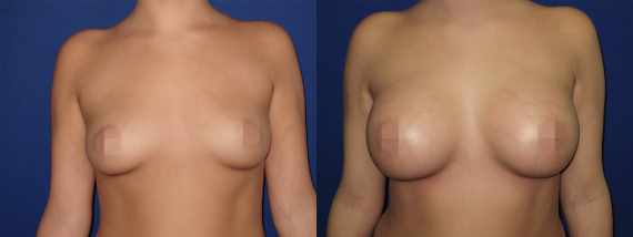 Foto před a po zvětšení prsou