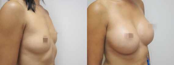 Foto před a po zvětšení prsou