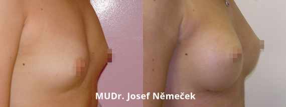 Foto před a po zvětšení prsou
