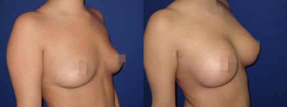 Foto před a po zvětšení prsou