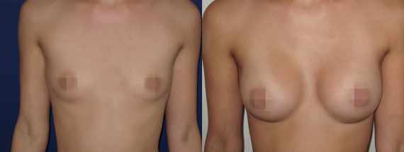 Foto před a po zvětšení prsou