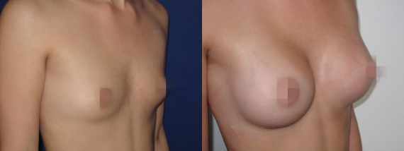 Foto před a po zvětšení prsou