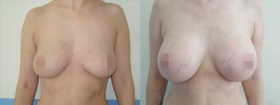 Foto před a po zvětšení prsou