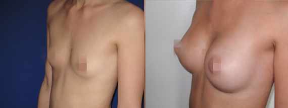 Foto před a po zvětšení prsou