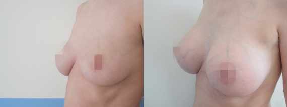 Foto před a po zvětšení prsou