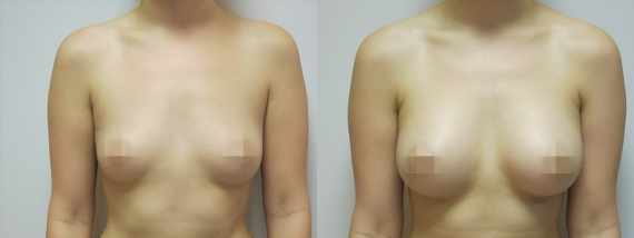 Foto před a po zvětšení prsou