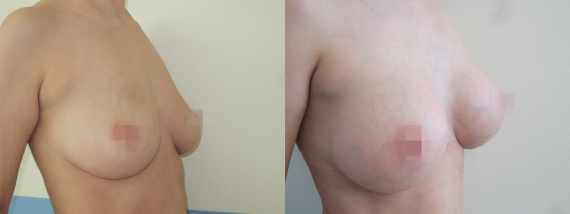 Foto před a po zvětšení prsou