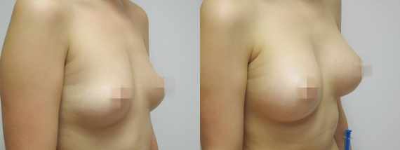 Foto před a po zvětšení prsou