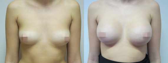 Foto před a po zvětšení prsou