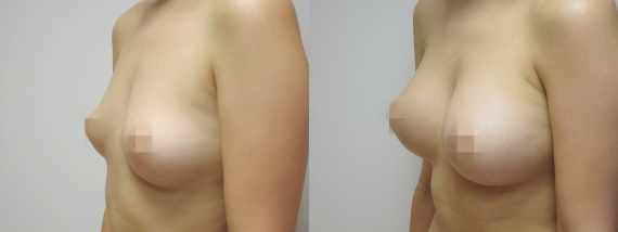 Foto před a po zvětšení prsou