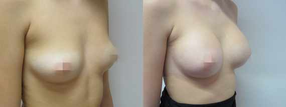 Foto před a po zvětšení prsou