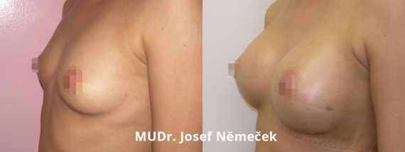 Foto před a po zvětšení prsou