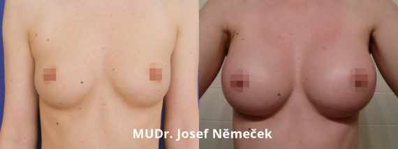 Foto před a po zvětšení prsou