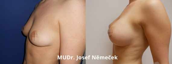 Foto před a po zvětšení prsou
