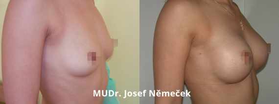 Foto před a po zvětšení prsou