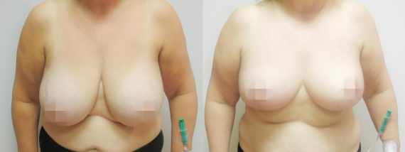 Před a po zmenšení prsou