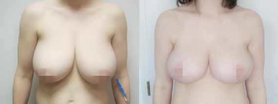 Před a po zmenšení prsou