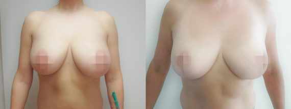 Před a po zmenšení prsou