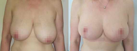 zmenšení prsou před a po