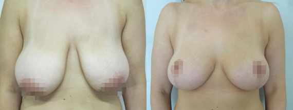 zmenšení prsou před a po