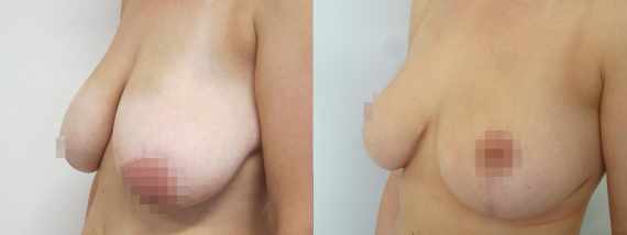 zmenšení prsou před a po