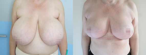 zmenšení prsou před a po