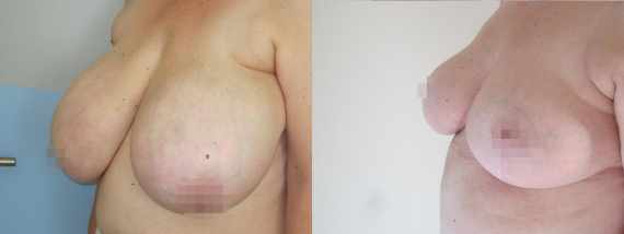 zmenšení prsou před a po