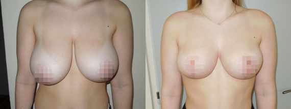 zmenšení prsou před a po