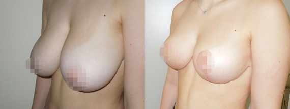 zmenšení prsou před a po
