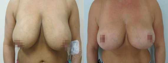 zmenšení prsou před a po